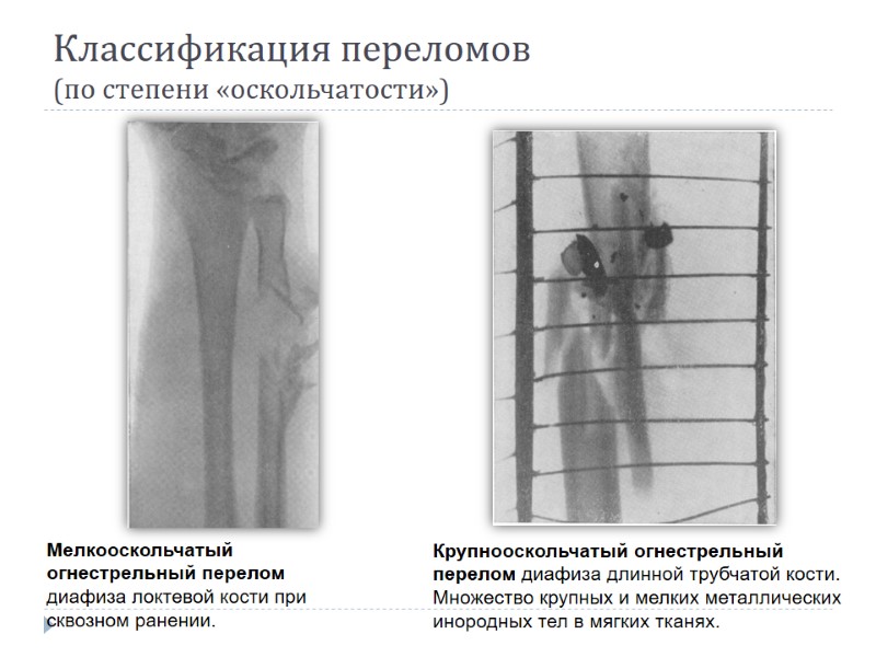 Классификация переломов  (по степени «оскольчатости») Крупнооскольчатый огнестрельный перелом диафиза длинной трубчатой кости. Множество